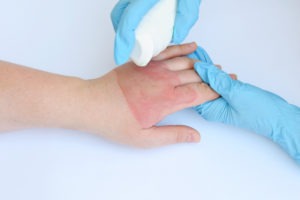 Los Angeles Burn Injury Lawyer