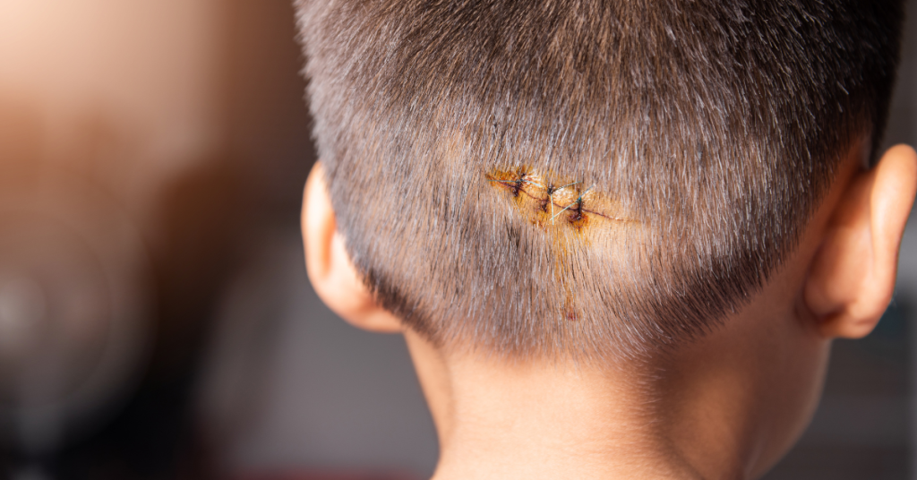 Why Should You Get a Laceration Injury Lawyer?